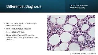 Subcutaneous Panniculitis like T cell lymphoma SPTCL