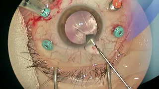 Logical approach to IOFB (Intraocular Foreign Body) treatment