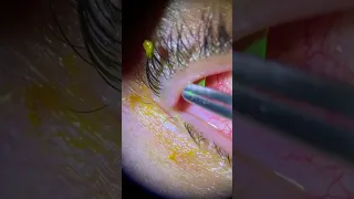 Removal of  A Torn Contact Lens From The Eye.  Has this ever happened to you?