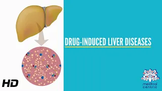 Drug-Induced Liver Disease, Causes, Signs and Symptoms, Diagnosis and Treatment.