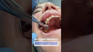 Как удалить имплантат? How to remove the implant? #dentist