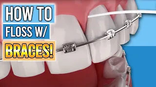 FLOSSING WITH BRACES: 3 Tools to Make Flossing With Braces Easy!