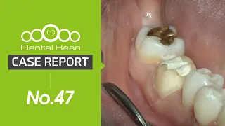 [MULTI_SUB] Monolithic zirconia crown preparation - [Dr. Na Kiwon]