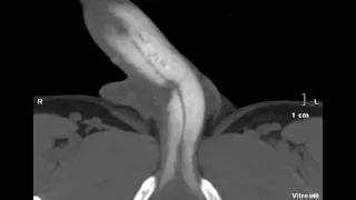 CT cavernosogram venous leak