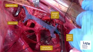 Laterally Extended Endopelvic Resection (LEER)