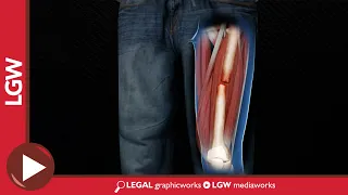 Summary of Injuries 3D Animation