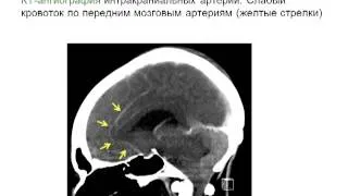 Смерть мозга Е.В.Гнедовская (2 МСН)