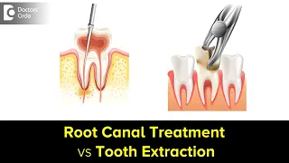 Root Canal Treatment vs Tooth Extraction. Which one is better?-Dr. Shahul Kamal Asif|Doctors' Circle