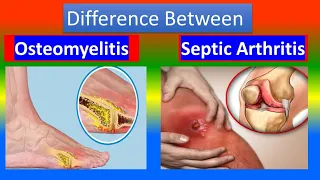 Distinction between Osteomyelitis and  Septic Arthritis