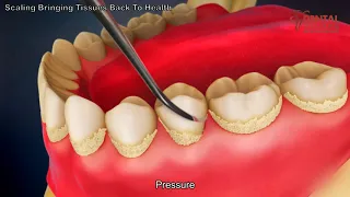 Teeth scaling to remove plaque - 3d animated video - Dental Solutions Clinic Bangalore