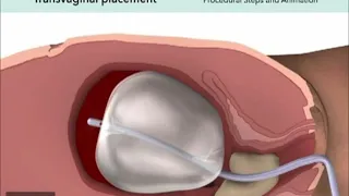 PPH: Uterine Tamponade