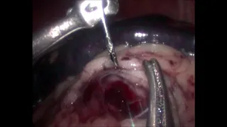 Videolaparoscopia com biópsia de um tumor abdominal com agulha Tru-Cut