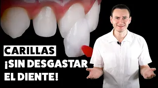 Carillas dentales ¡SIN DESGASTE! Una excelente opción | CASO REAL