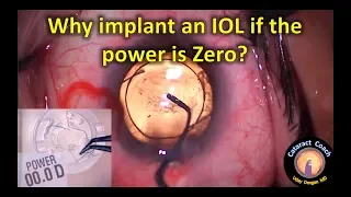 Why you must still implant the IOL even if the power is zero (Myopia Cataract Surgery)