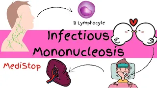 Infectious Mononucleosis | SINGS & SYMPTOMS, PATHOPHYSIOLOGY, DIAGNOSIS & TREATMENT