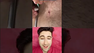 JUICY pimple over an ingrown hair