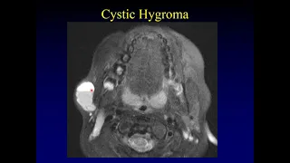 Imaging of Cystic Neck Masses, Part 1 of 2