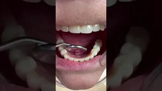 Протезирование зубов All-on-4 с немедленной нагрузкой сразу после операции в клинике Неватекс Москва