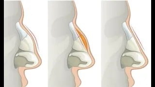 Post op septorhinoplasty / septoplasty advice