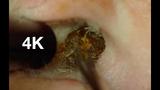 4K : HD : EAR WAX REMOVAL : ANOTHER MASSIVE PLUG