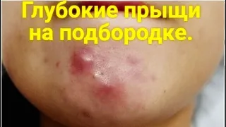 Глубокие прыщи на подбородке. Почему прыщи появляются и что с ними делать?