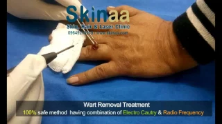 This is How Warts( Massa) are Removed --Live Treatment