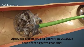 Como é feita a Cirurgia de Pedra nos Rins? Vídeo da cirurgia em 3D 2024