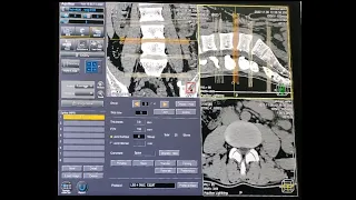 شرح فحص الاشعه المقطعيه علي الفقرات القطنيه / CT Lumbar Spine