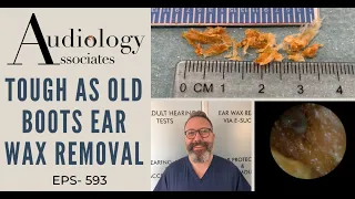 TOUGH AS OLD BOOTS EAR WAX REMOVAL - EP593