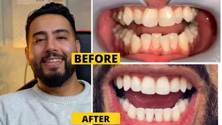 Is INVISALIGN worth it? - MY REVIEW - everything you need to know