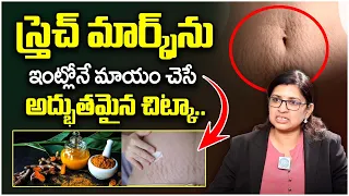 Dr  lalitha - చర్మం పై ఒక్కటంటే ఒక్క Stretch Marks ఉండదు || Stretch Marks in Telugu || iDream Health