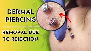 Dermal Piercings | Removal (Due to Rejection) 💎❌