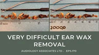 VERY DIFFICULT EAR WAX REMOVAL - EP170