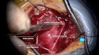 Операция при Мальформации Киари у ребенка. Нейрохирург Землянский М.Ю.