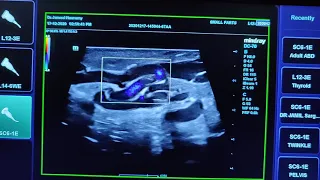 Varicocele with Reflux Ultrasound