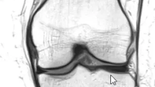 How to Read an MRI of the Knee | First Look MRI