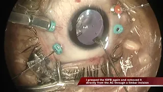 Intraocular Foreign body in the macular area