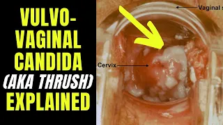 Doctor explains VULVOVAGINAL CANDIDIASIS (aka thrush) - including causes, symptoms & how to treat...