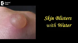 Skin Blisters with Water: Causes, Treatment, Draining, Prevention - Dr.Aruna Prasad | Doctors Circle