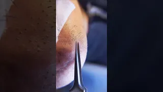 ingrown hair pull out speedx2 with tweezers!  Satisfying 244 #shorts #satisfying  #well  #removal
