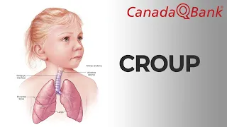 Croup (Laryngotracheobronchitis)
