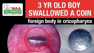 Foreign body Coin in Cricopharynx | Dr.K.R.Meghanadh | MAA ENT Hospitals