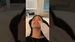 Lip filler treatment