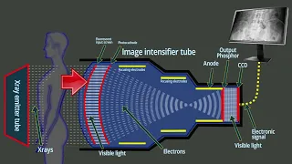 Fluoroscopy : Xray intensifier tube - Basic functions