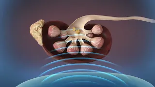 Kidney Stones Shockwave Lithotripsy (SWL)