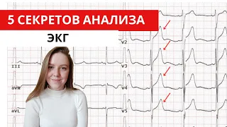 5 секретов анализа ЭКГ