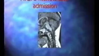 Autoimmune Mechanisms and Superantigens in Transverse Myelitis