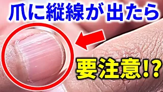 【爪でわかる！】爪に縦線が出たら要注意！？爪でわかるあなたの健康