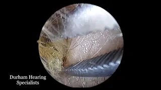 Dead skin adhered to ear canal
