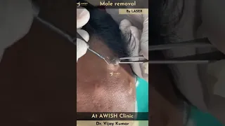 Mole on forehead Removal by RF | Painless mole removing #mole #remove #moles #awishclinic #shorts